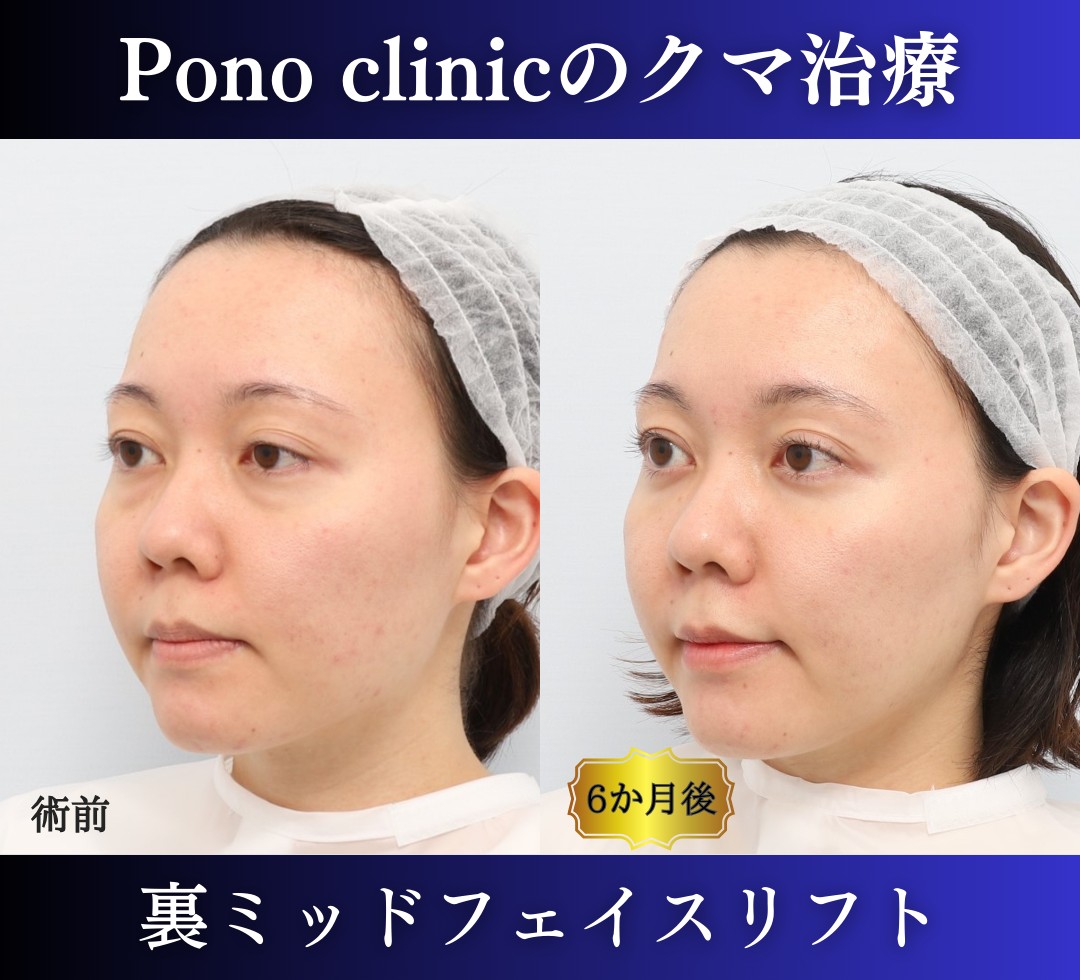 クマ取り東京、裏ミッドフェイスリフトの症例、半年右