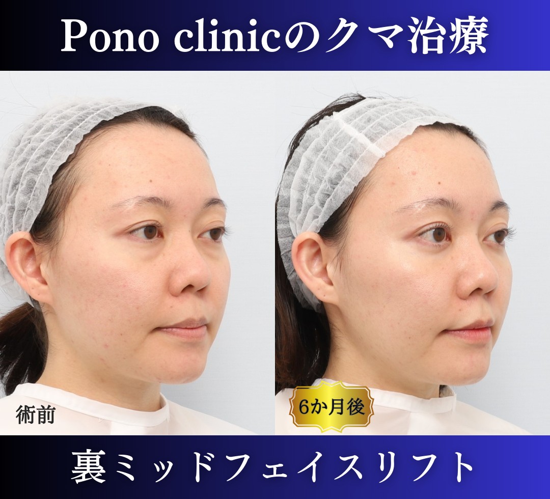 クマ取り東京、裏ミッドフェイスリフトの症例、半年左
