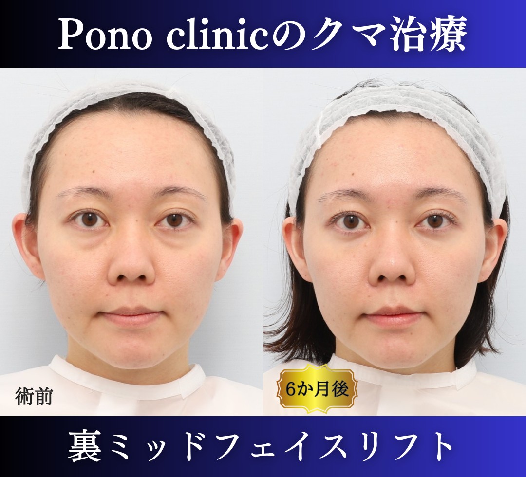 クマ取り東京、裏ミッドフェイスリフトの症例、半年正面