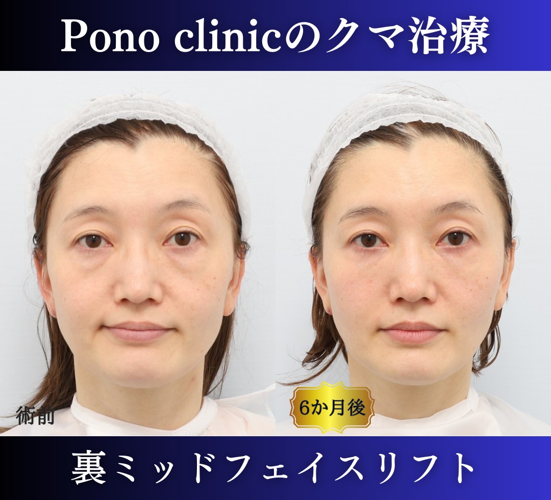 クマ取り東京、40代のクマ治療、裏ミッドフェイスリフトの症例 (1)