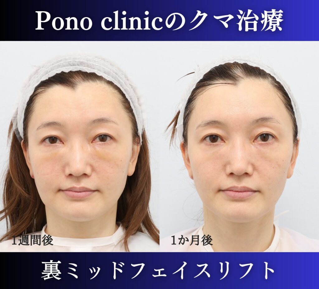 40代のクマ治療、裏ミッドフェイスリフトの症例 (2)