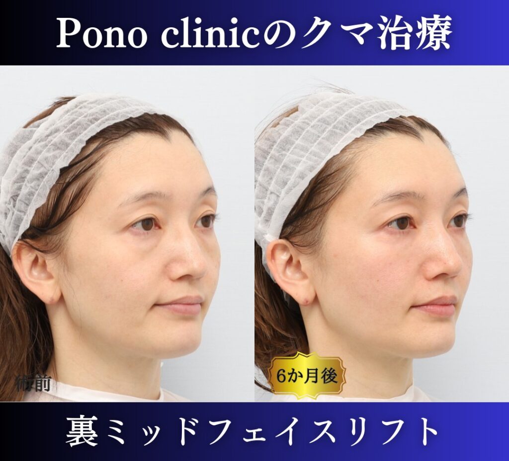 40代のクマ治療、裏ミッドフェイスリフトの症例 (3)