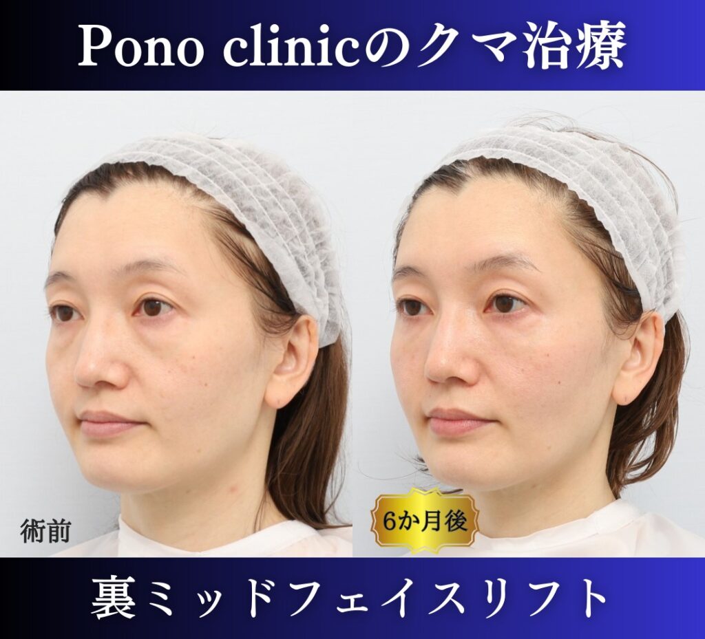 40代のクマ治療、裏ミッドフェイスリフトの症例 (4)