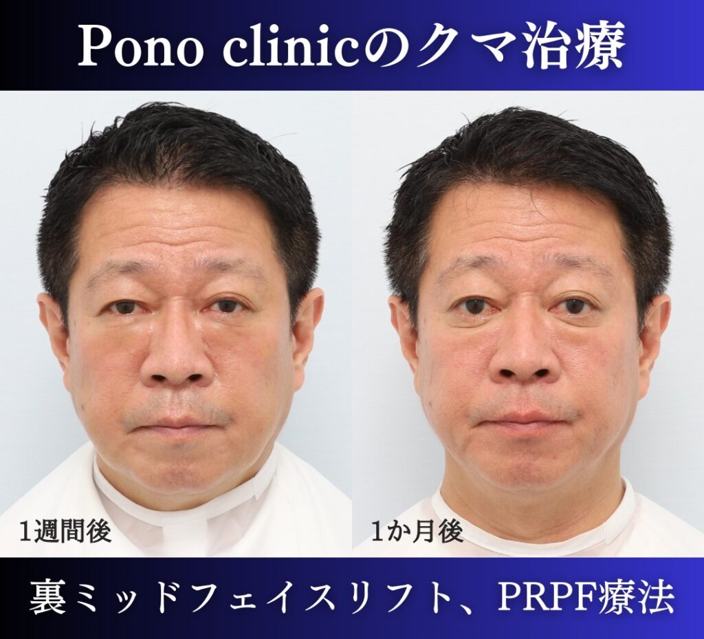 50代のクマ治療、 裏ハムラ+ミッドフェイスリフト、PRPF療法目の下 (2)