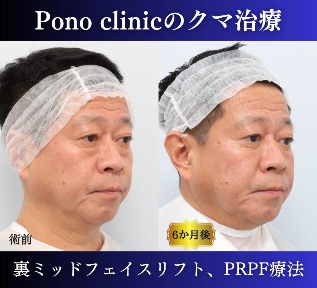 50代のクマ治療、 裏ハムラ+ミッドフェイスリフト、PRPF療法目の下 (4)