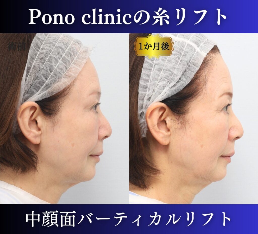 中顔面バーティカルリフトの症例、PCLLA6本使用 (2)