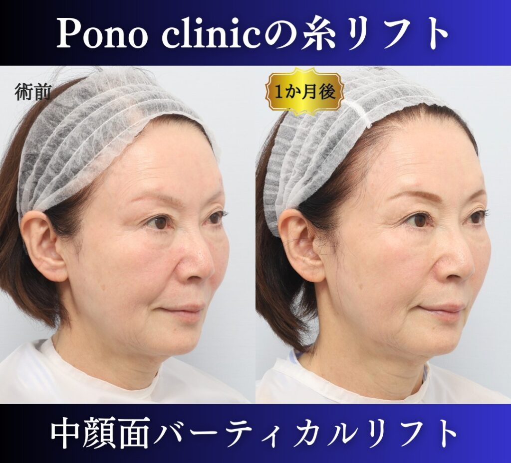 中顔面バーティカルリフトの症例、PCLLA6本使用 (3)