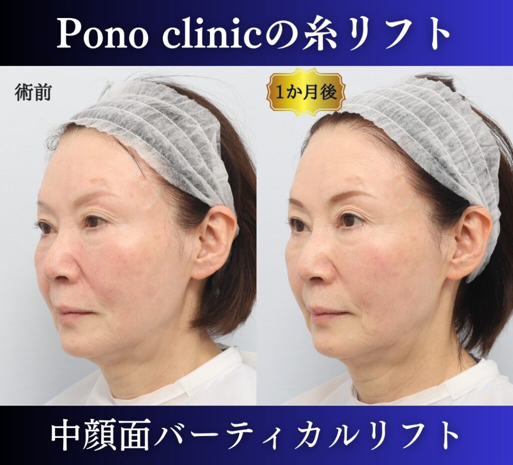 中顔面バーティカルリフトの症例、PCLLA6本使用 (4)