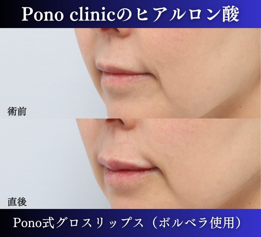 唇ヒアルロン酸注入、40代 (1)