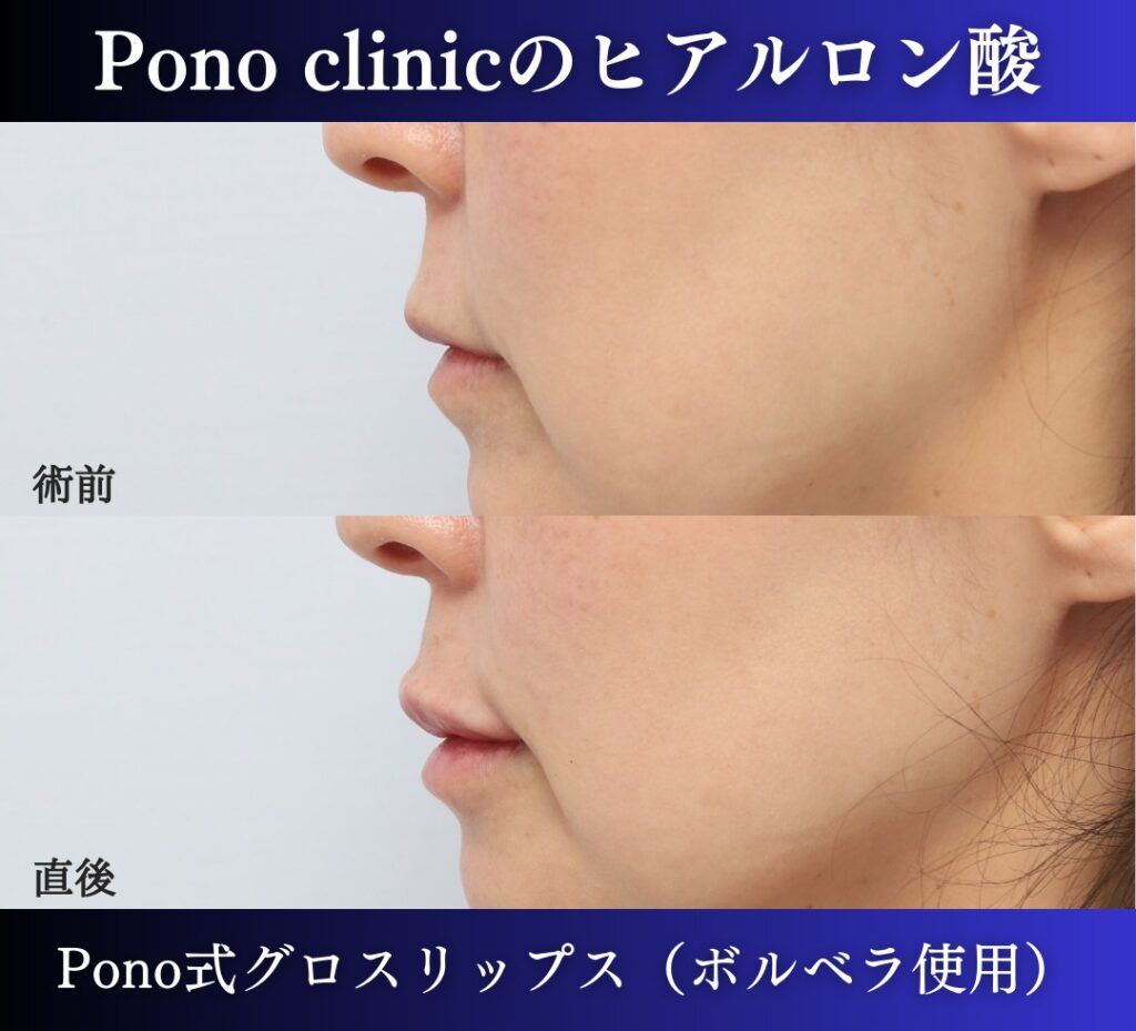 唇ヒアルロン酸注入、40代 (2)