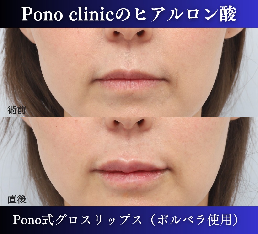唇ヒアルロン酸注入、40代 (3)