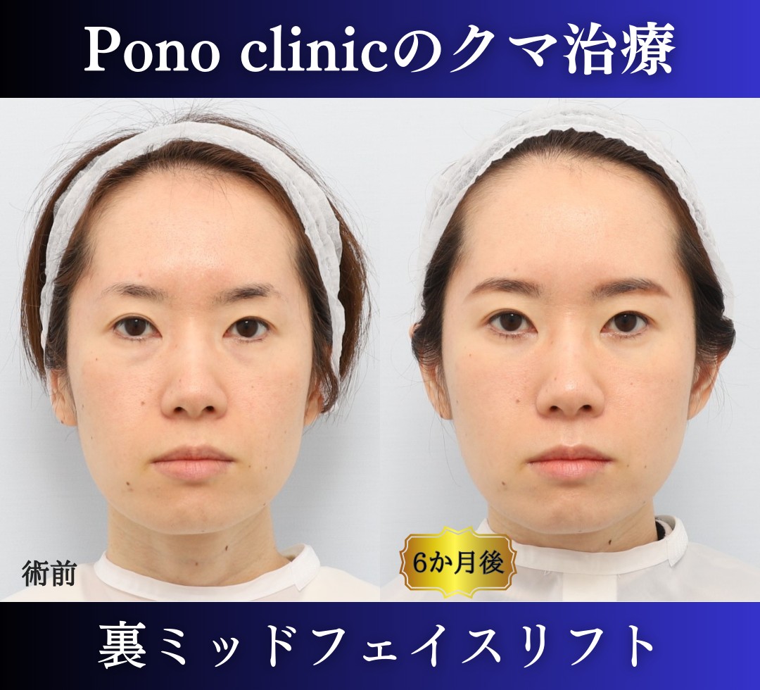 クマ取り東京、裏ハムラ+ミッドフェイスリフトの症例、30代 (1)