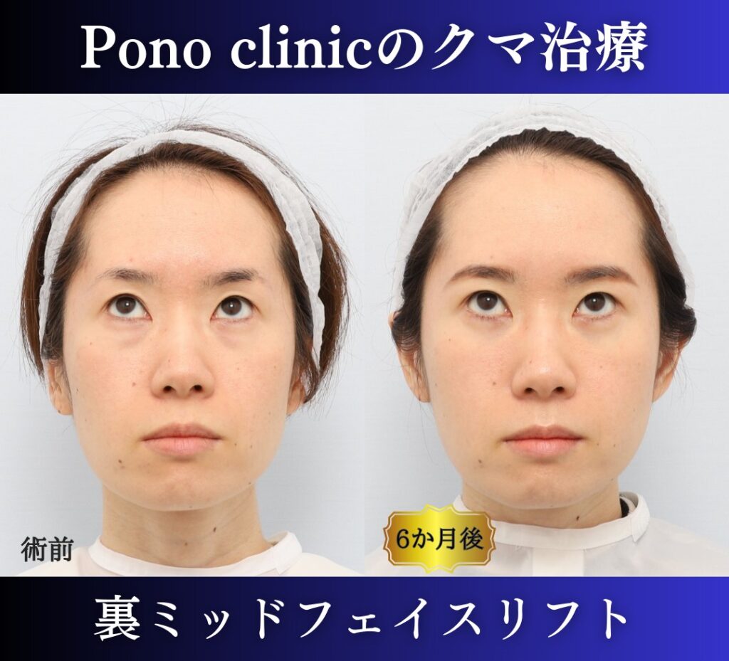 裏ハムラ+ミッドフェイスリフトの症例、30代 (2)