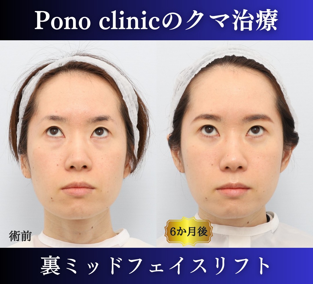 クマ取り東京、裏ハムラ+ミッドフェイスリフトの症例、30代 (2)