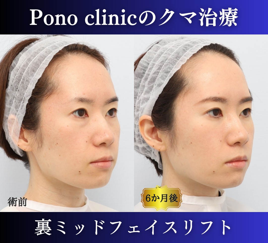 クマ取り東京、裏ハムラ+ミッドフェイスリフトの症例、30代 (3)