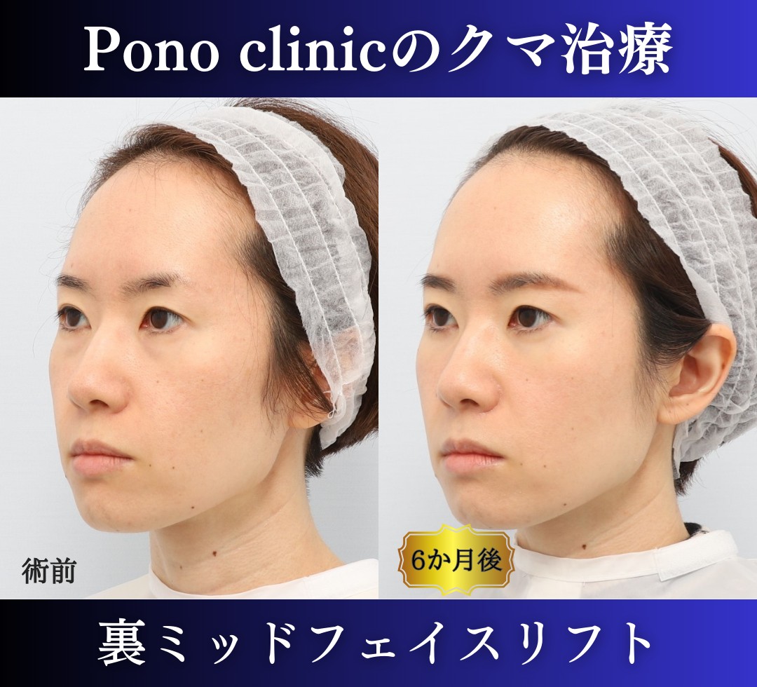 クマ取り東京、裏ハムラ+ミッドフェイスリフトの症例、30代 (4)