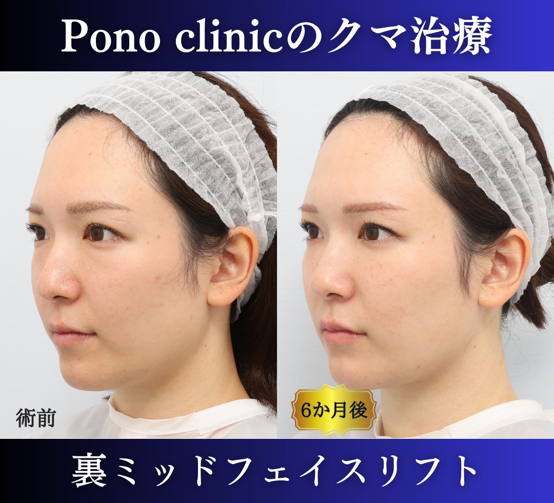 クマ取り東京、裏ハムラ法+ミッドフェイスリフトの症例、30代 (7)