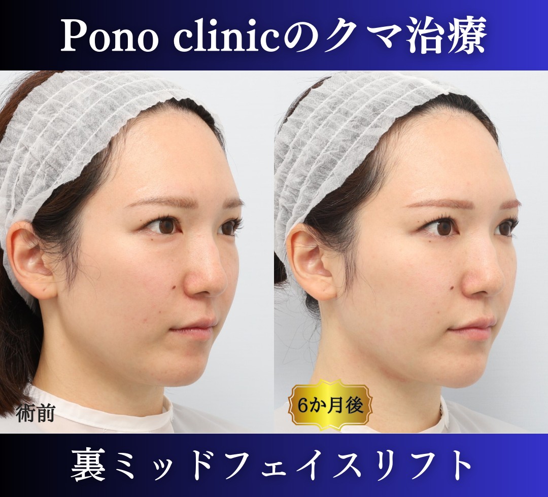 クマ取り東京、裏ハムラ法+ミッドフェイスリフトの症例、30代 (8)