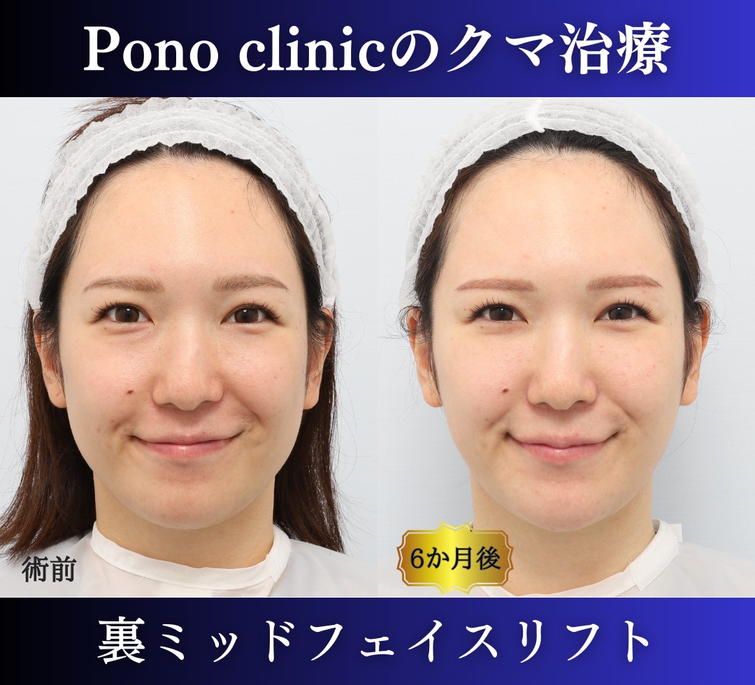 クマ取り東京、裏ハムラ法+ミッドフェイスリフトの症例、30代 (9)