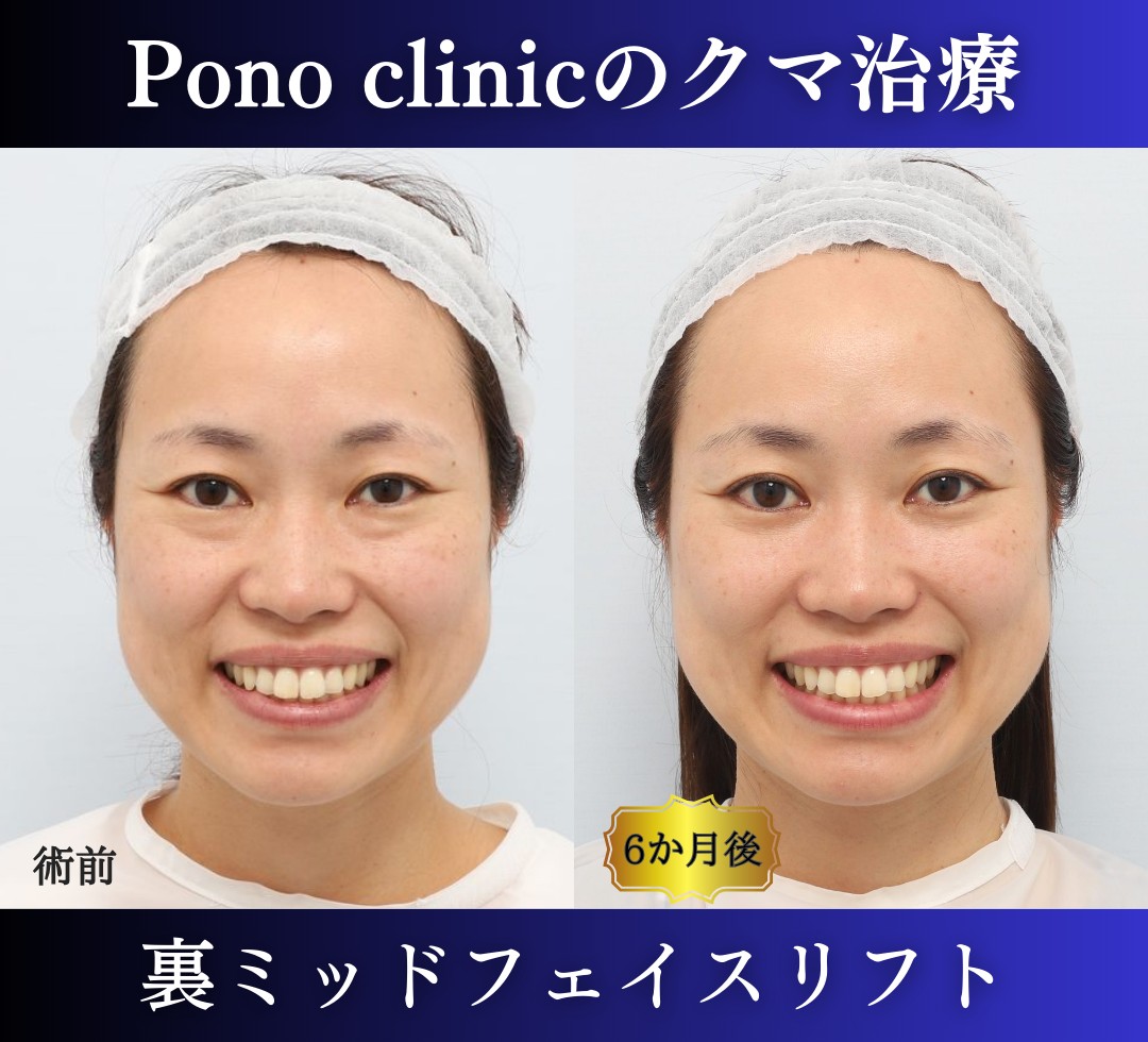 クマ取り東京、30代女性、裏ミッドフェイスリフト