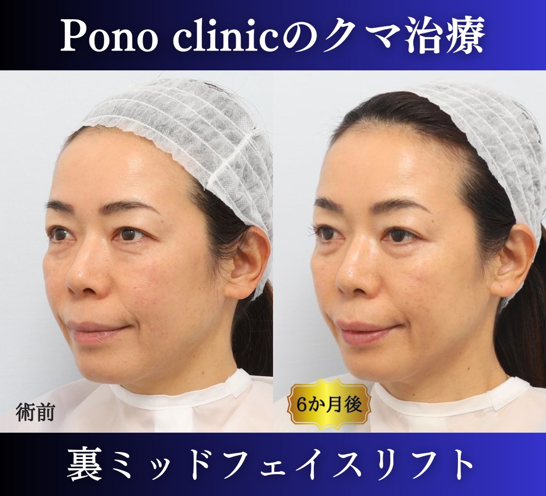 クマ取り東京、50代のクマ治療、裏ミッドフェイスリフト (2)