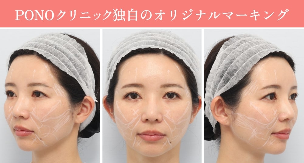 ハイフ(HIFU)の施術方法