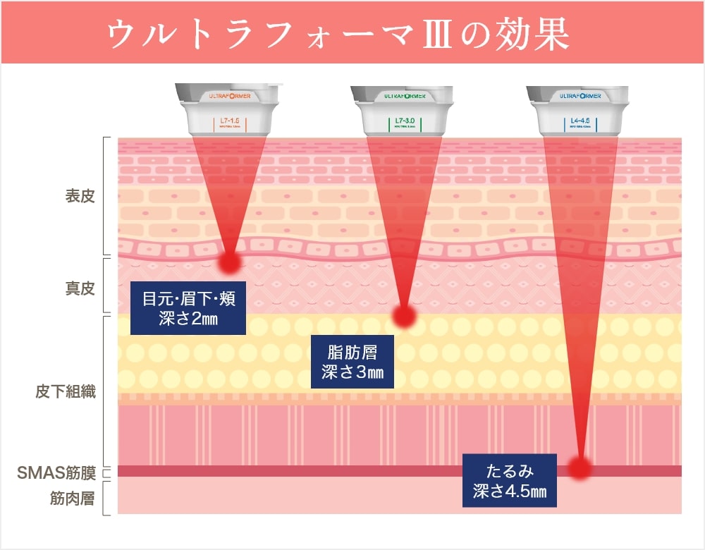 ハイフ(HIFU)ウルトラフォーマーⅢとは