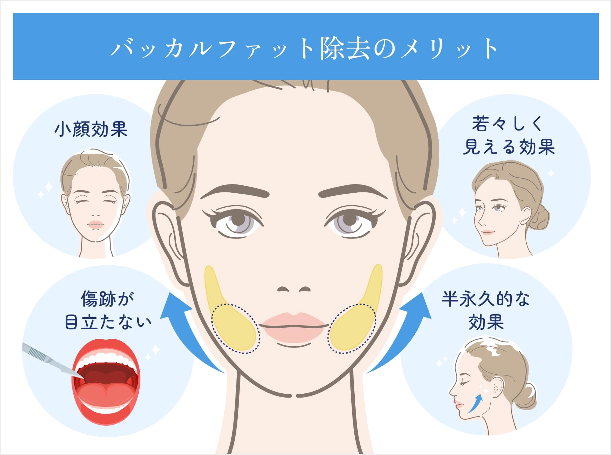 バッカルファット除去のメリット