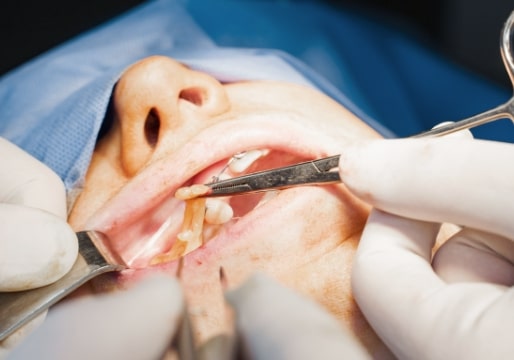 施術の流れ 脂肪の除去