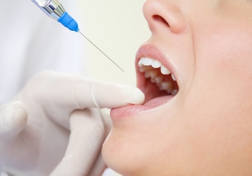 施術の流れ 口 麻酔