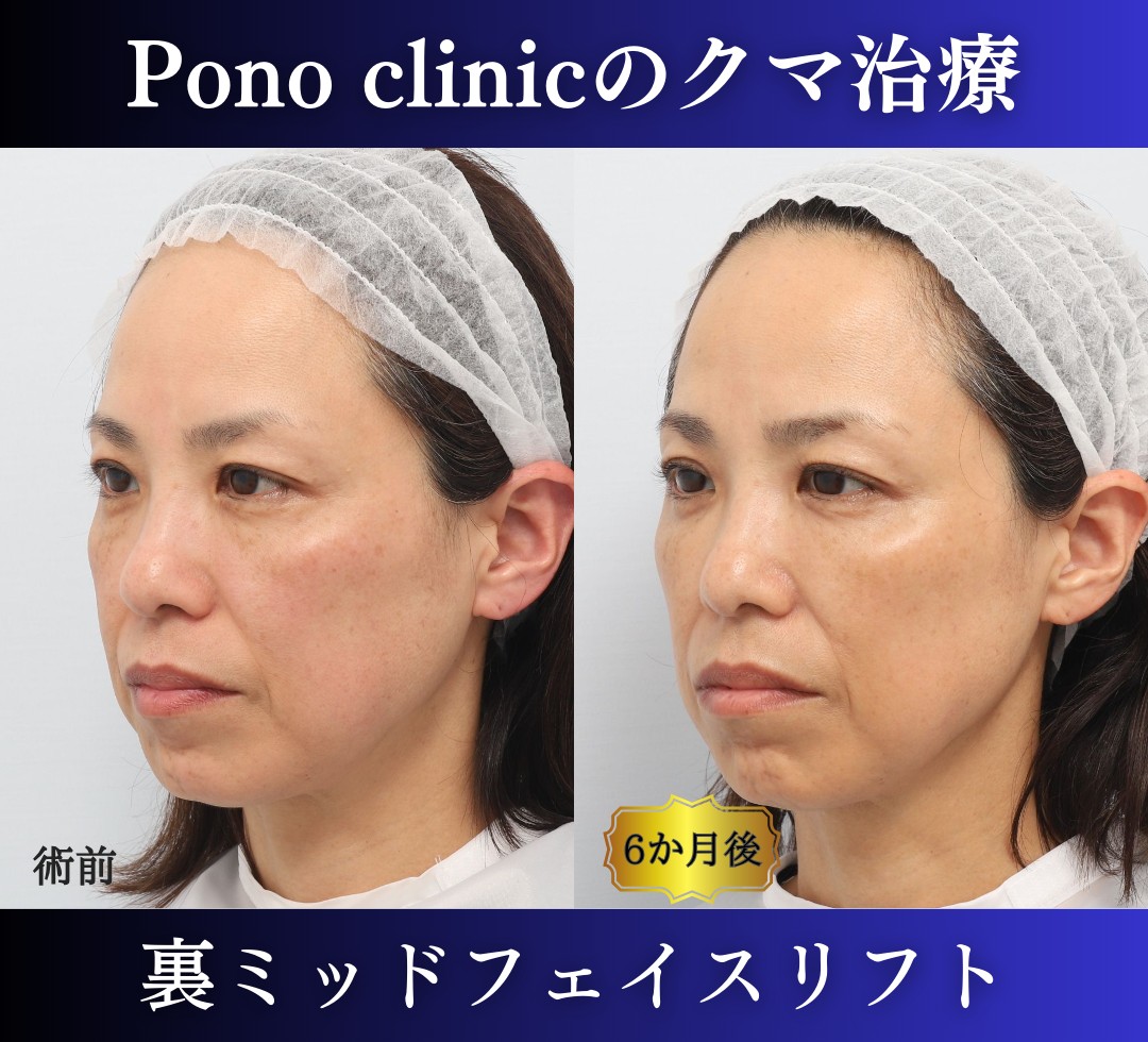 クマ取り東京、裏ミッドフェイスリフト、40代女性の症例 (3)