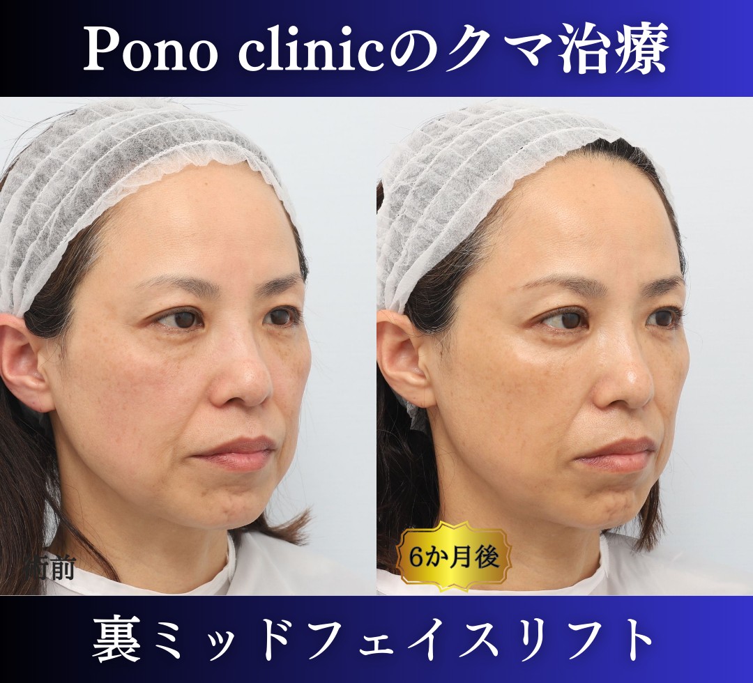 クマ取り東京、裏ミッドフェイスリフト、40代女性の症例 (4)