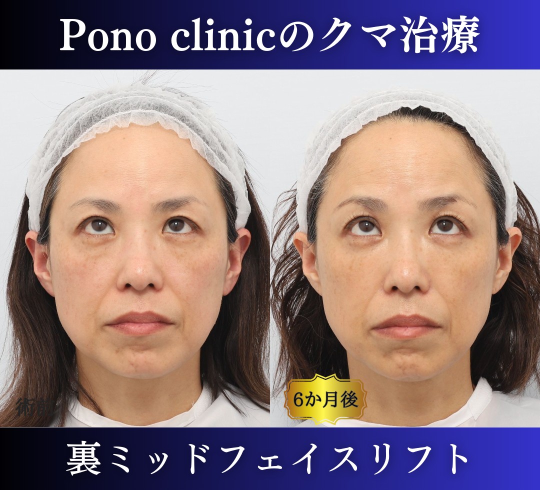 クマ取り東京、裏ミッドフェイスリフト、40代女性の症例 (5)