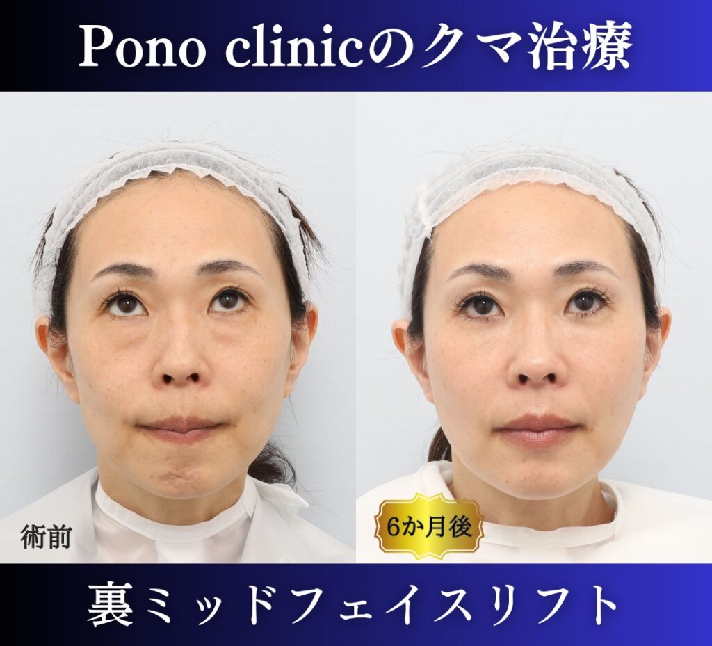 裏ミッドフェイスリフト、PRPF療法法令線、40代女性の症例 (2)