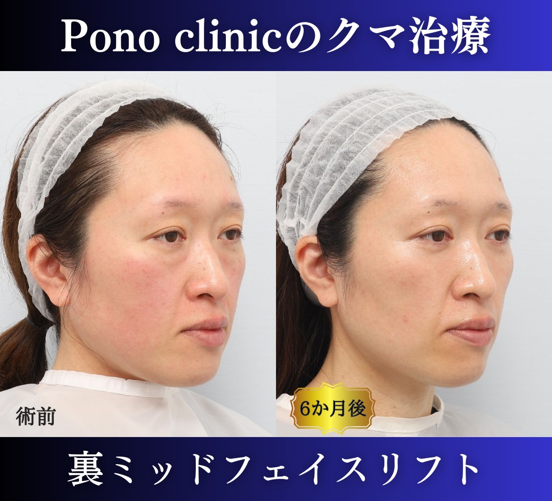 クマ取り東京、40代女性、クマ治療（裏ミッドフェイスリフト） (2)