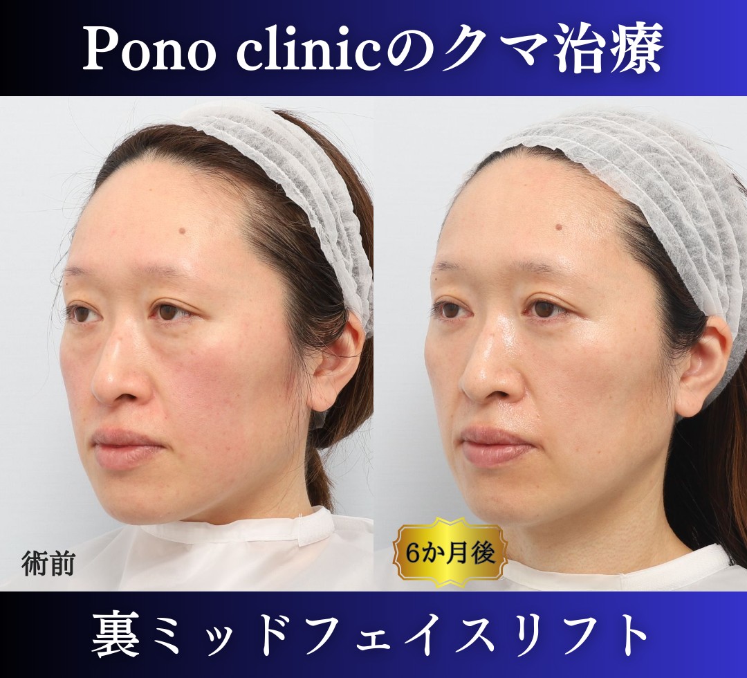 クマ取り東京、40代女性、クマ治療（裏ミッドフェイスリフト） (3)