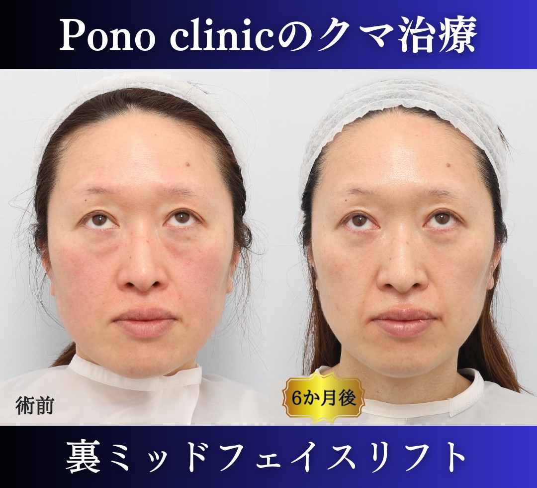 クマ取り東京、40代女性、クマ治療（裏ミッドフェイスリフト） (4)