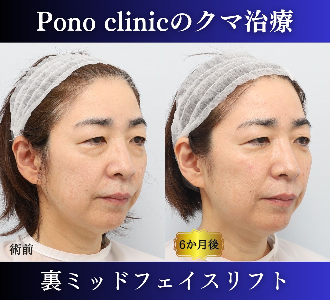 クマ取り東京、50代のクマ治療、裏ミッドフェイスリフト (2)