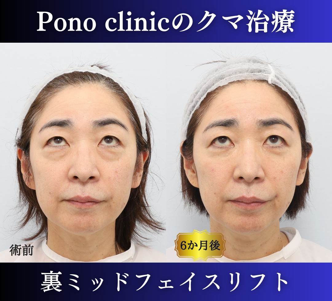 クマ取り東京、50代のクマ治療、裏ミッドフェイスリフト (4)