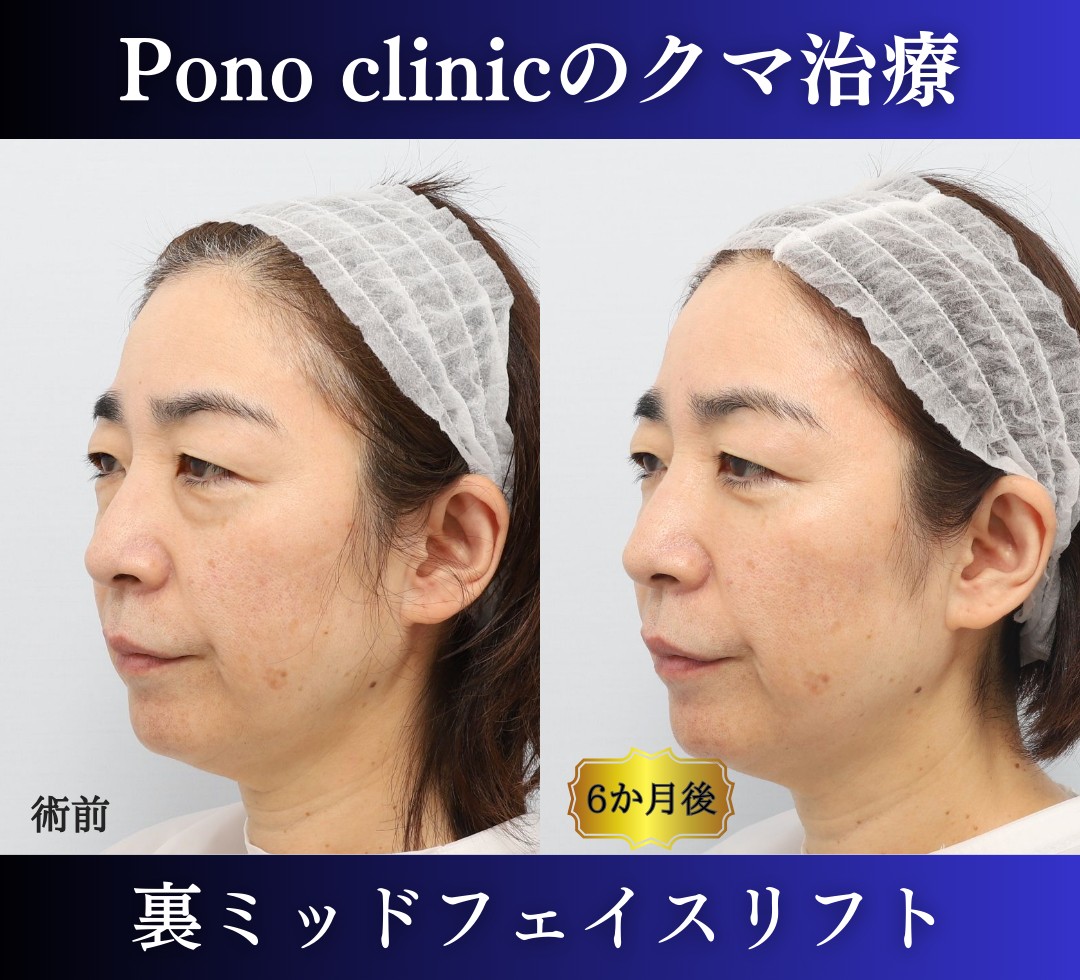 クマ取り東京、50代のクマ治療、裏ミッドフェイスリフト