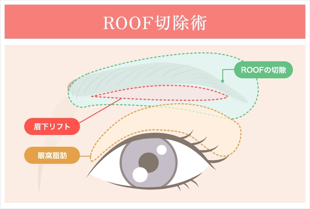 ROOF切除術