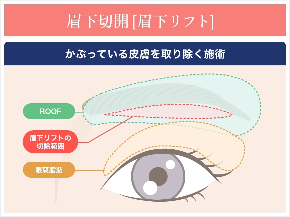 眉下切開(眉下リフト)とは