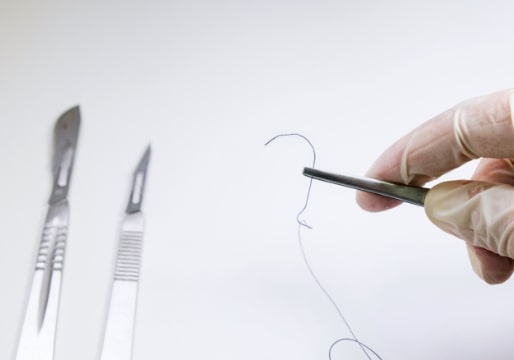 施術の流れ 抜糸