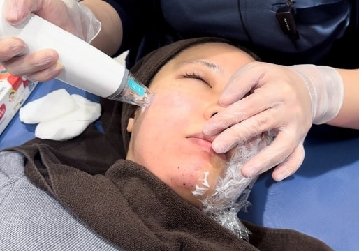 施術の流れ 施術 ポテンツァ