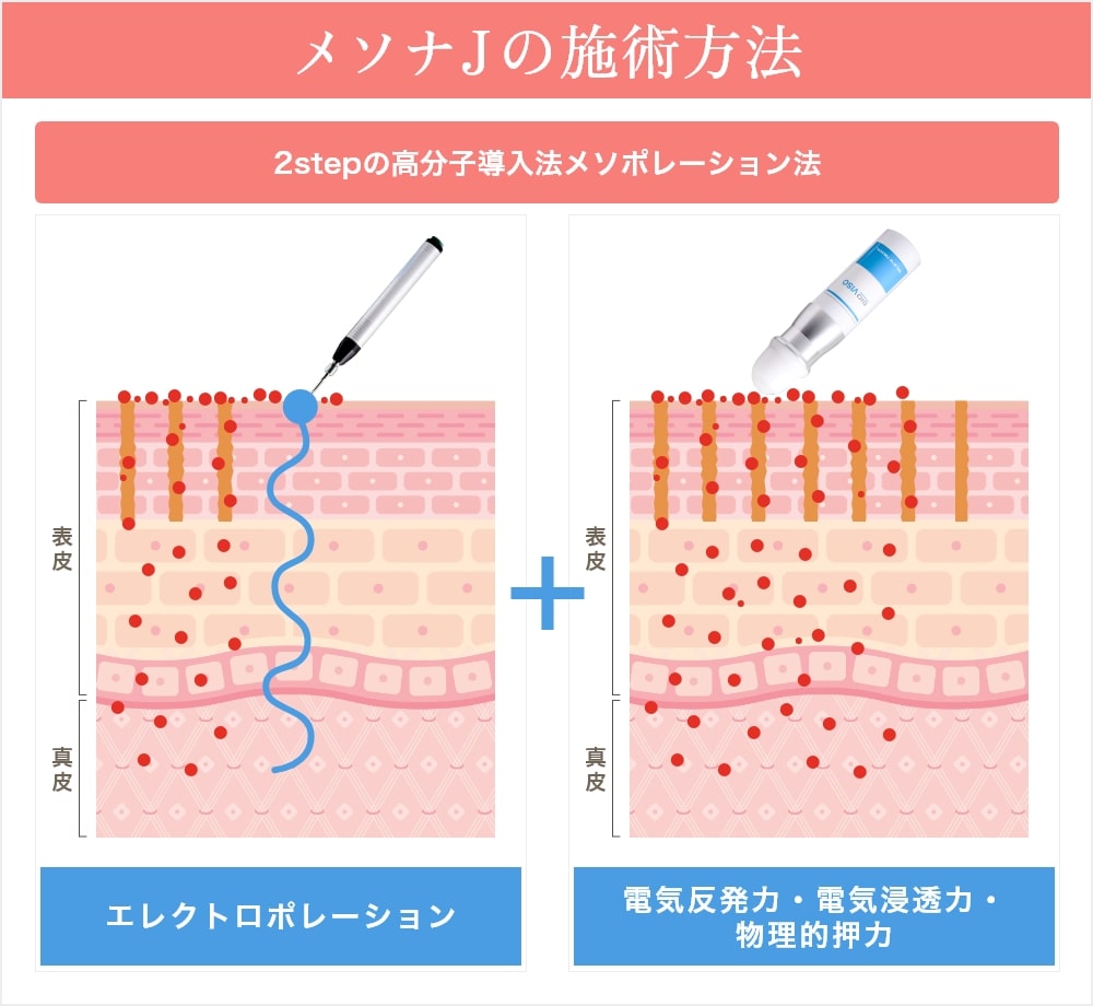 メソナJの施術方法