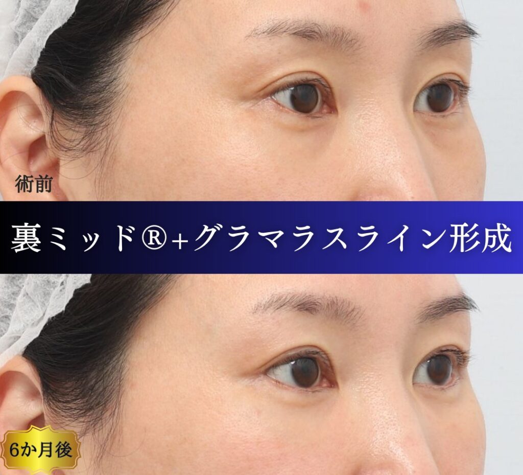 クマ取り東京、裏ミッドフェイスリフト®、グラマラスライン形成、目尻切開の症例、40代女性 (3)