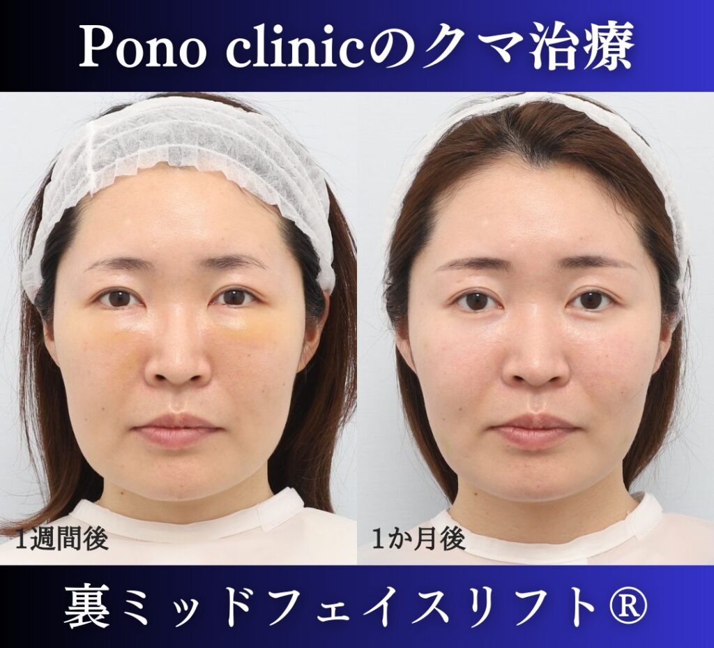 クマ取り東京、裏ミッドフェイスリフト、30代女性の症例 (1)