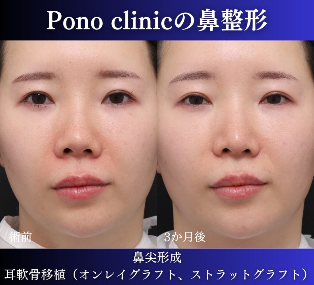 鼻尖形成、軟骨移植の症例 (1)