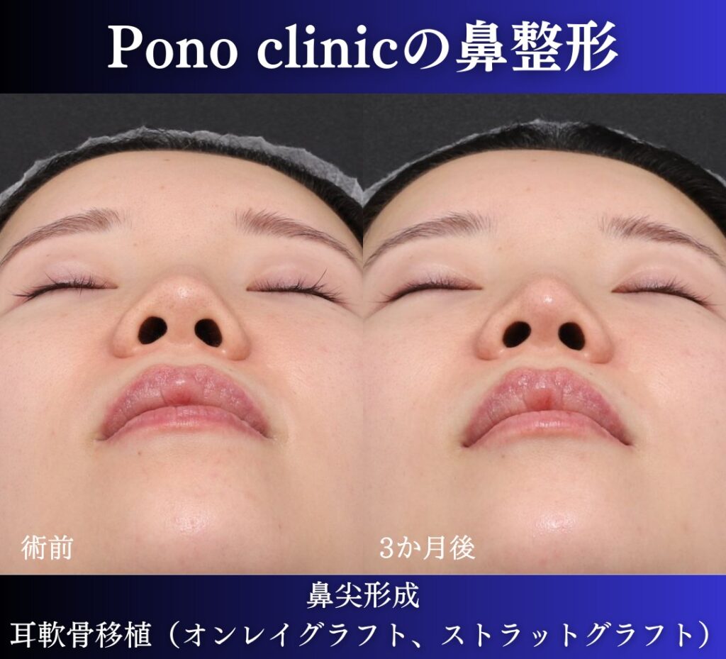 鼻尖形成、軟骨移植の症例 (2)