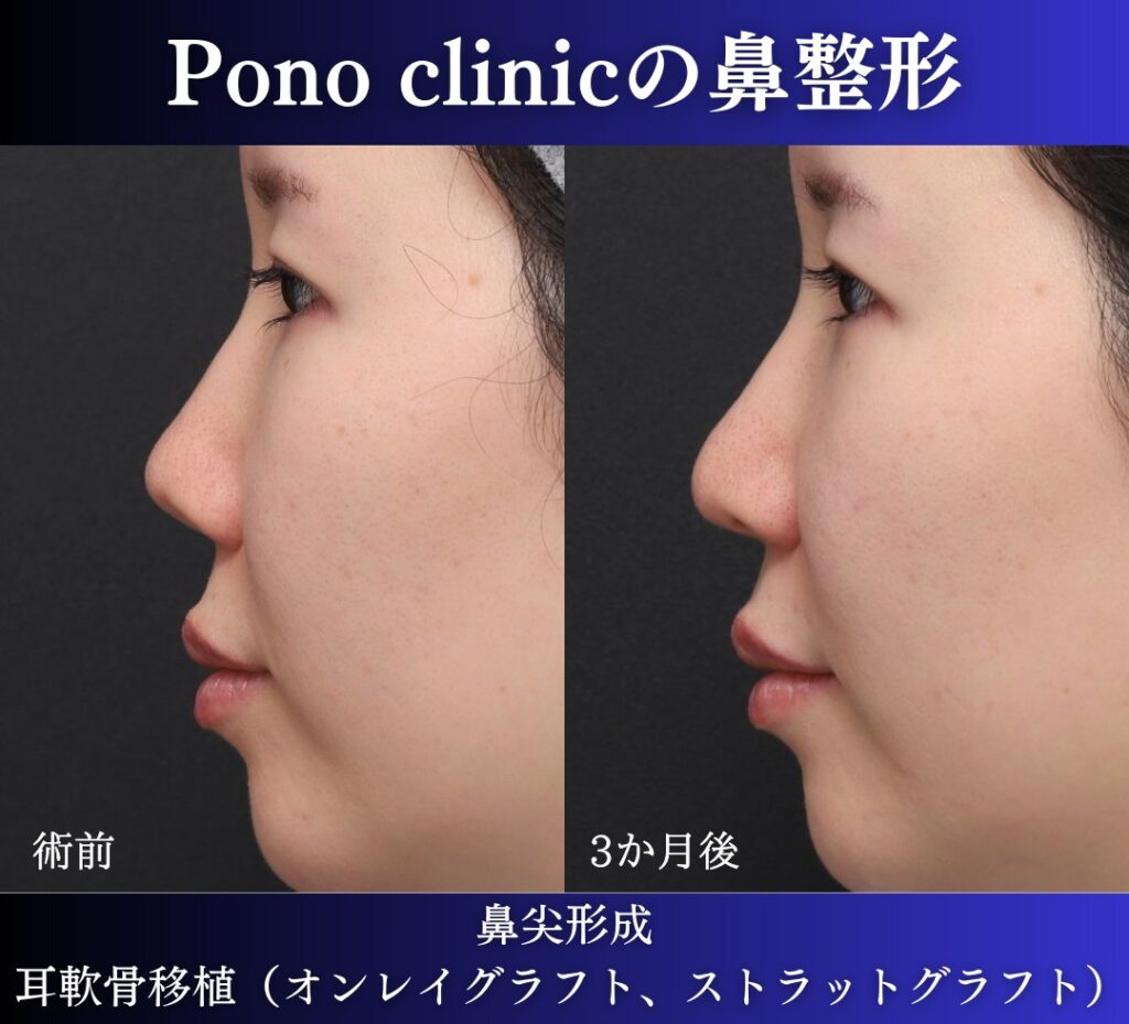 鼻尖形成、軟骨移植の症例 (3)